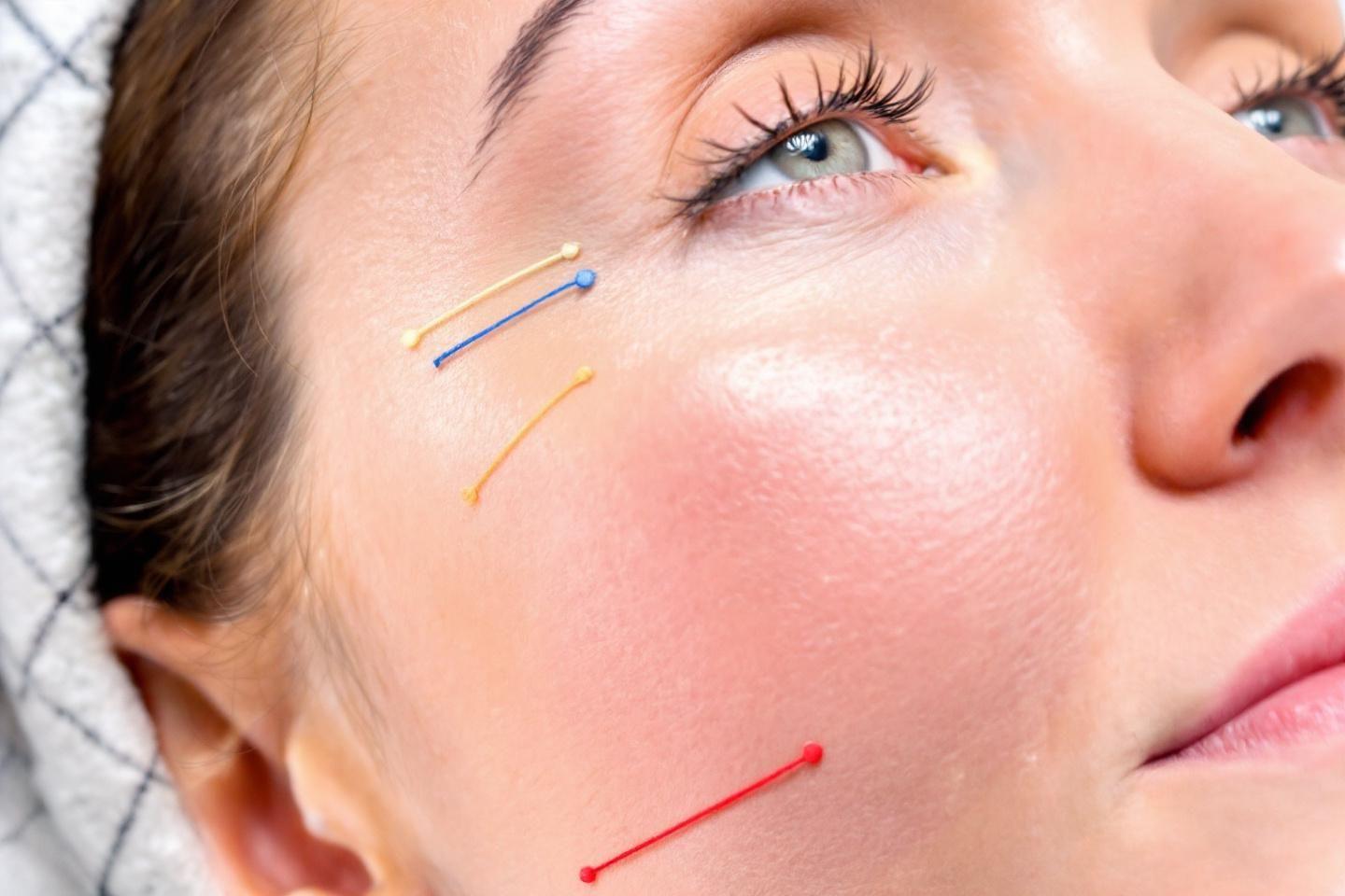 Combien de fils tenseurs pour le visage faut-il prévoir selon les zones à traiter ?